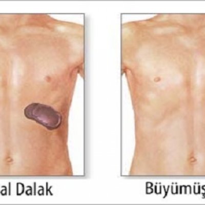 Dalak Büyümesi (Splenomegali) 